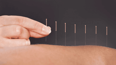 Image for Acupuncture