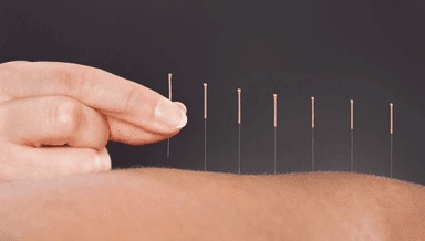 Image for 1st Acupuncture Treatment with Assessment